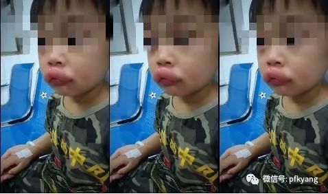 男孩吃葡萄過敏腫成嘟嘟嘴怎么回事？畫面詳情曝光網友忍不住笑了